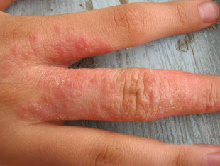 Skin rash at worms